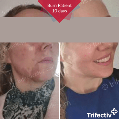 Hot oil burn on face cleared after 10 days