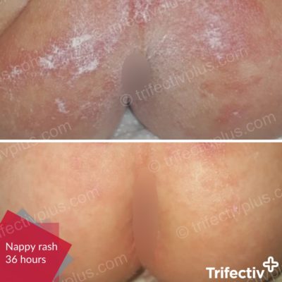 Nappy rash improved after 36 hours