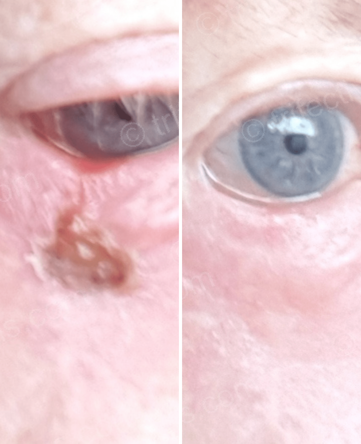The use of hypochlorous acid in an irradiation ulcer of the lower eyelid
