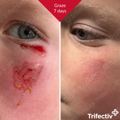 Graze on the face resolved in 7 days