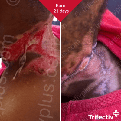 Neck burn on a toddler resolved in 3 weeks with minimal scarring and no contraction