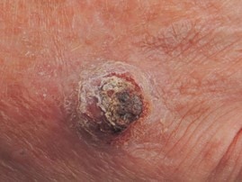 Squamous cell carcinoma Trifectiv