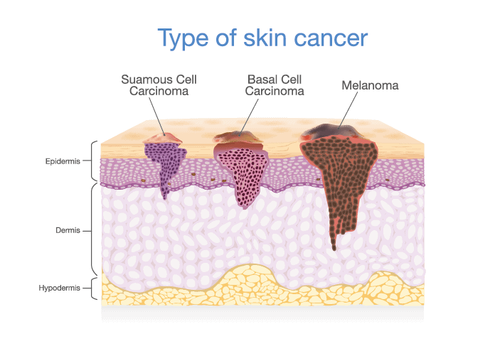 Skin cancer types compared Trifectiv