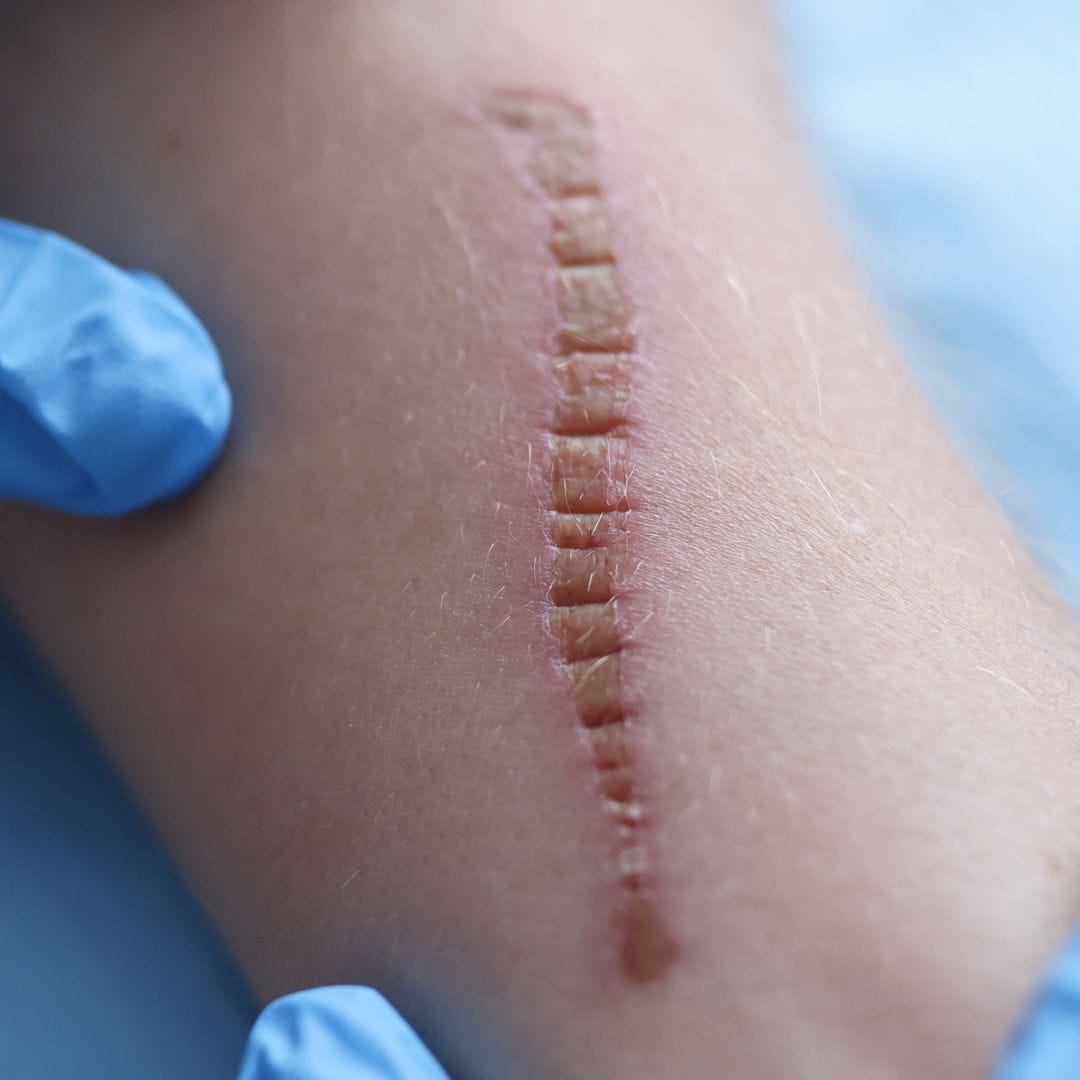 wound healing stages Trifectiv